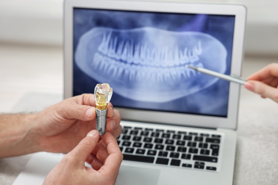 Quelles sont les causes de l'agénésie dentaire ?